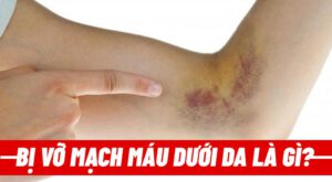 Bị vỡ mạch máu dưới da là gì?Có nguy hiểm không? Kiến Thức Thể Hình sẽ giúp bạn trả lời câu hỏi này qua chi tiết bài viết....